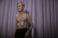 Muž prežil útok na Nagasaki, kusy kože z neho viseli ako handry: Pohľad na to zničené telo bude bolieť aj vás