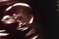Také malé a také šikovné: Bábätko na ultrazvuku poslalo mame jednoznačný odkaz!
