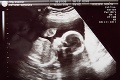 Šla ku gynekológovi a nastal šok: Na ultrazvuku videla tvár svojej babky!