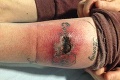 Dala si tetovanie, trpko to oľutovala: Namiesto ozdoby má dieru v nohe!