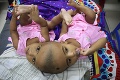 Siamské dvojčatá, ktorým po 33 hodinách oddelili lebky a mozgy: Na toto lekári čakali celé týždne