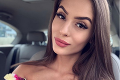 Prekrásna česká youtuberka 9 mesiacov po príšernom popálení: Prvý raz ukázala tvár!