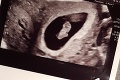 Nečakané zistenie počas ultrazvuku: To, čo odhalil lekár, Katie položilo