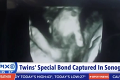 Matka čaká dvojičky, no schyľuje sa k tragédii: Detail na fotke z ultrazvuku rozplakal celý svet!
