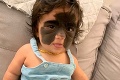 Dievčatko sa narodilo s obrím znamienkom na tvári: Po hrozivých slovách lekárov prepadla rodičov panika