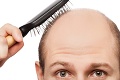 Ako zvrátiť stratu vlasov u mužov? Objavte zázračnú zložku, ktorá dokáže divy