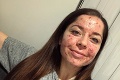 Mladú ženu roky trápilo príšerné akné: Teraz je z nej nový človek! Odrovná vás, ako vyzerá po liečbe