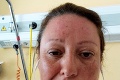 Vysnívaná dovolenka sa zmenila na horor: Žena sa zobudila s ochrnutou tvárou!