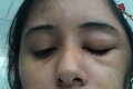 Žena si myslela, že ju oči svrbia kvôli alergii: Šokujúca diagnóza