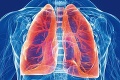 Pacientov z vážnou chorobou pľúc pribúda: Zatiaľ sa nedá zastaviť, len spomaliť