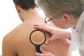 Nebezpečenstvo, ktoré je priamo na očiach: Odborníci radia, ako jednoducho predísť rakovine kože