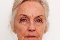 Babička podstúpila lifting tváre aj napriek varovaniam doktorov: Po zákroku je z nej úplne nový človek