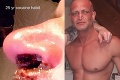 Mužovi po 25 rokoch šnupania kokaínu doslova vybuchol nos: FOTKA len pre silné žalúdky!