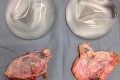 Erika si dala prsné implantáty, problémy prišli krátko po operácii: Mala chuť vytrhnúť si ich z tela