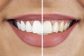 Pozor na domáce bielenie zubov: Aké riziká sa spájajú s túžbou po hollywoodskom úsmeve?