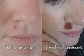 Žena porazila rakovinu kože: O rok ju malá vyrážka na tvári vrhla do najhoršej nočnej mory