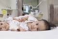 15-mesačné siamské dvojičky úspešne oddelili: Po operácii už stihli i niekoľko šibalstiev