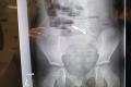 Chlapec sa sťažoval na bolesti brucha: Spravili mu röntgen, neuveríte, čo našli v jeho žalúdku