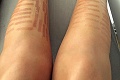 Odborné odstránenie chĺpkov sa skončilo katastrofou: Zuzane laser spálil nohy