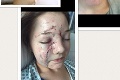Hororová bitka: Matka rozbila sklo o tvár mladej ženy, tá znáša doživotné následky