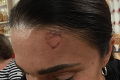 Česká herečka si popálila čelo: Keď uvidíte tvar jej rany, pochopíte, prečo sa nad ňou rozplýva