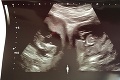 Žena otehotnela zvláštnym spôsobom a porodila dvojičky: Šanca na takýto fenomén je 1 ku 500 miliónom