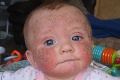Bábätko trpelo nepríjemným ekzémom: Po liečbe steroidovými krémami sa stalo na nich závislé