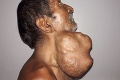 Muž nosil na tvári takmer 1,5 kilový nádor: To, ako vyzeral predtým, vás šokuje!