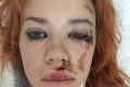 Speváčka skupiny Peter Bič Project mala nehodu: Hororový záber na jej znetvorenú tvár!