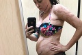 Budúca mamička, ktorá utrpela popáleniny na 80 % tela, ukázala bruško: Tieto jazvy skrývala celé roky!