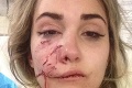 Mladá žena chcela byť modelkou, jej sen zničil útok agresívneho psa: Teraz má zmrzačenú tvár!
