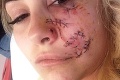 Mladá žena chcela byť modelkou, jej sen zničil útok agresívneho psa: Teraz má zmrzačenú tvár!