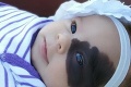 Dievčatko sa narodilo s obrovským znamienkom na tvári: Teraz má dva roky, pozrite, ako vyzerá