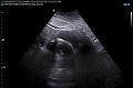 Jedna z najtučnejších žien sveta otehotnela: Porodila dvojkilové bábätko s dierami v srdci!