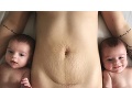 Telo čerstvej mamičky už nikdy nebude ako predtým: Trúfli by ste si zverejniť takú intímnu fotku?