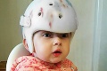 Milotka (2) z Levíc má kruté ochorenie a musí žiť s helmou na hlavičke: S mamou majú 236 € na mesiac