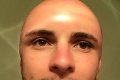 Muž si vyholil hlavu, von vyšiel bez opaľovacieho krému: Fotky jeho lebky sú hitom internetu