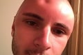 Muž si vyholil hlavu, von vyšiel bez opaľovacieho krému: Fotky jeho lebky sú hitom internetu