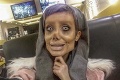 Žena (19) chcela vyzerať ako Angelina Jolie, výsledok je desivý: Po plastikách sa jej zľaknete aj za bieleho dňa!