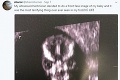 Žena zverejnila fotku z ultrazvuku, každému udrel do očí desivý detail: Drsná reakcia na jej bábätko!