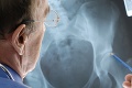 Osteoporóza nie je na Slovensku dostatočne diagnostikovaná: Trpia ňou státisíce pacientov