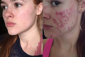Dievčina si pravidelne fotila tvár s ťažkou formou akné: Posledný záber vás rozhodne zaskočí!