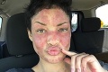 Žena bojuje s vážnym ochorením kože: Kvôli znetvorenej tvári ani nevychádzala z domu!