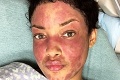 Žena bojuje s vážnym ochorením kože: Kvôli znetvorenej tvári ani nevychádzala z domu!