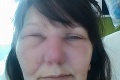 Anita sa pri práci v záhradke poškriabala v nose: Život ohrozujúca infekcia zmenila jej tvár na nepoznanie!