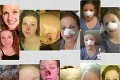Mladá žena si myslela, že má na nose len vyrážku: Smrtiaca choroba zohavila jej tvár na nepoznanie!
