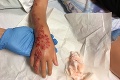 Dievčatko si prešlo na dovolenke v Egypte peklom: Hrôzostrašné následky po tetovaní hennou!