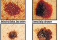 Rakovinou kože trpí čoraz viac Slovákov: Kedy ísť so znamienkom k lekárovi?