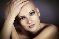 Lenka sa stala vyhľadávanou modelkou: Choroba jej vzala vlasy, ale nie krásu!