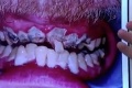 Mladík si viac ako 20 rokov neumýval zuby: Teraz ukázal, ako vyzerá jeho chrup!